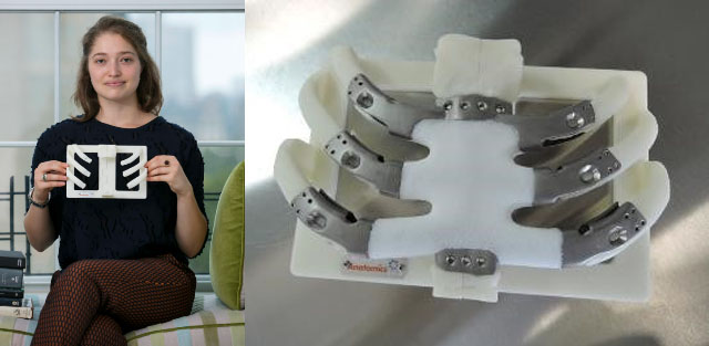 Patient holding the 3d model template used to create a titanium and polymer sternum
